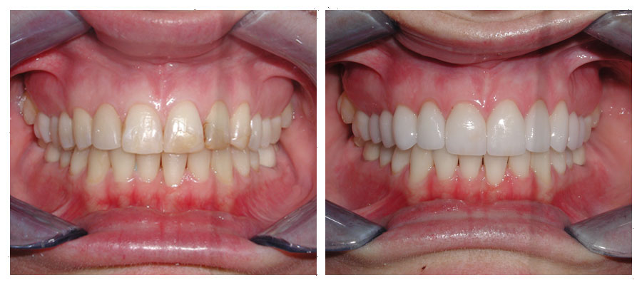 patient who received 8 dental veneers after car accident