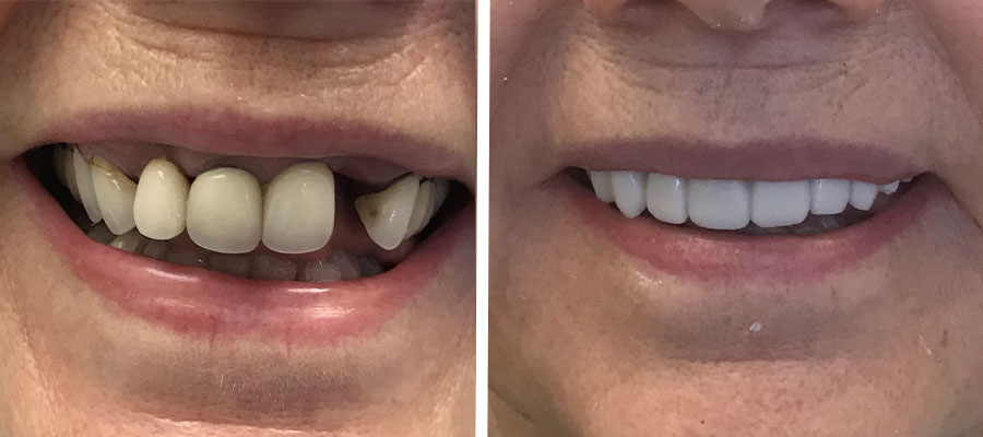 immmediate denture