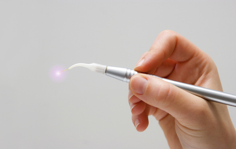 Closup of the wand, a tool used during laser dentistry treatments at Santa Teresa Dental Center in San Jose CA.