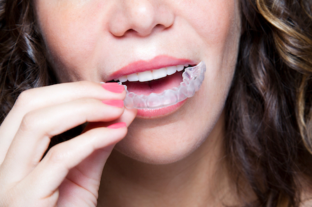 Woman inserting the top tray of her invisalign braces she got at Santa Teresa Dental Center in San Jose CA.