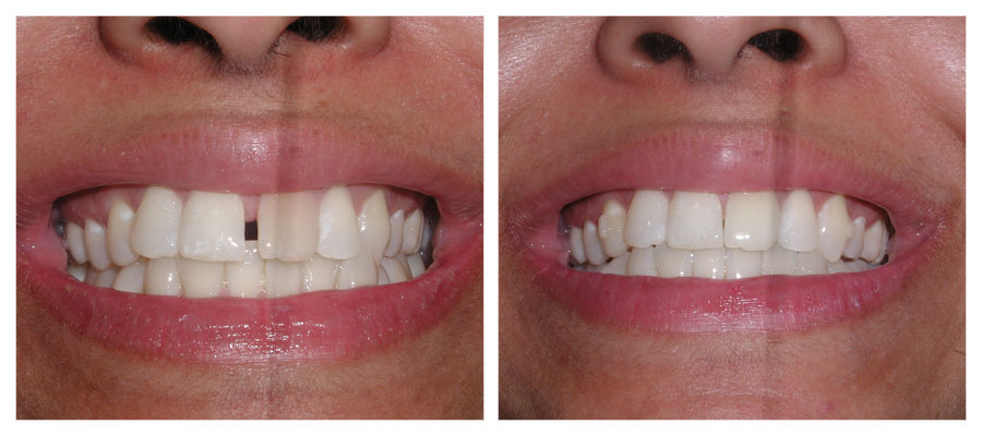 before and after photos of a patient who had their teeth straigthened with Invisalign and then whitened