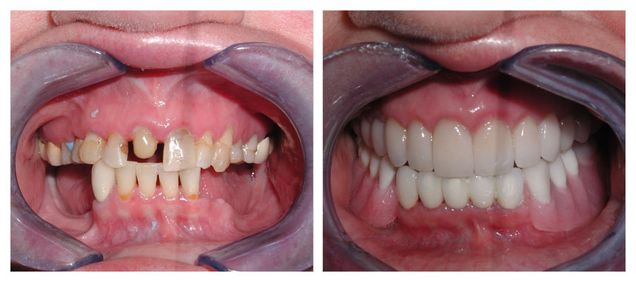 before and after photos of a patient who had full mouth reconstruction to restore their smile