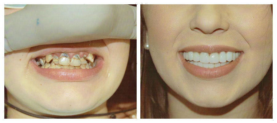 before and after of a patient who had full mouth reconstruction surgery at Santa Teresa Dental Center