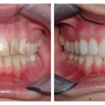 patient who received 8 dental veneers after car accident